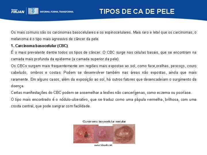 TIPOS DE CA DE PELE Os mais comuns são os carcinomas basocelulares e os