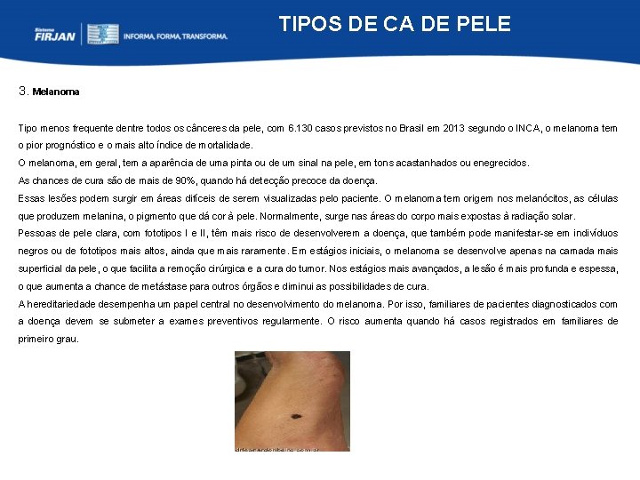 TIPOS DE CA DE PELE 3. Melanoma Tipo menos frequente dentre todos os cânceres