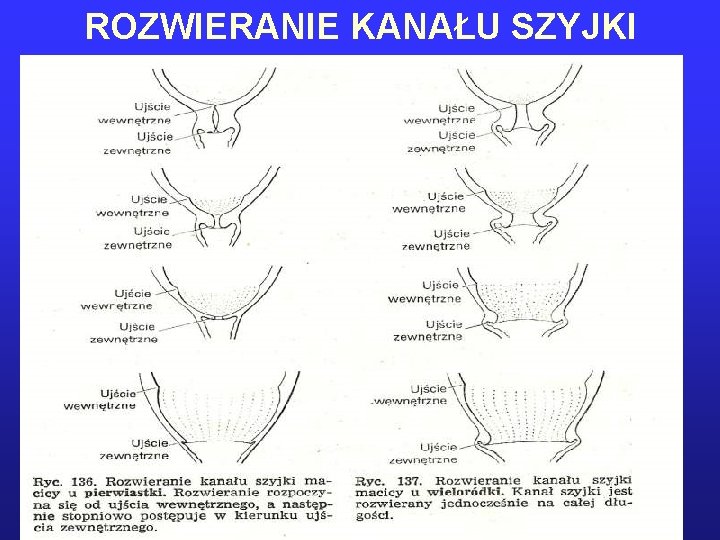 ROZWIERANIE KANAŁU SZYJKI 