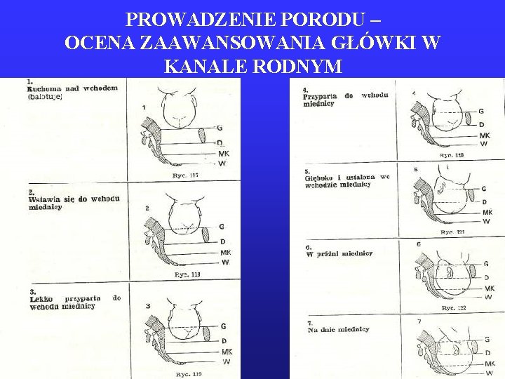 PROWADZENIE PORODU – OCENA ZAAWANSOWANIA GŁÓWKI W KANALE RODNYM 