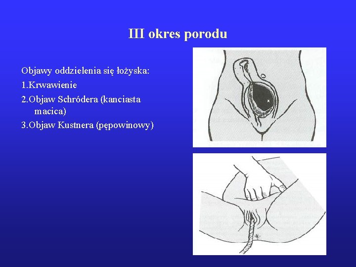 III okres porodu Objawy oddzielenia się łożyska: 1. Krwawienie 2. Objaw Schródera (kanciasta macica)