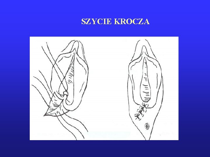 SZYCIE KROCZA 