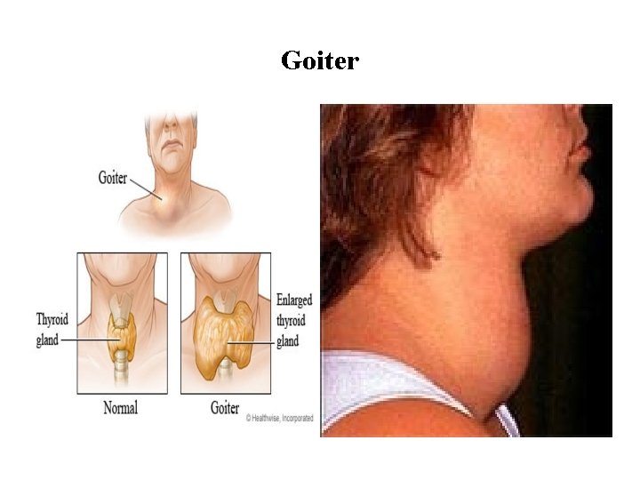 Goiter 