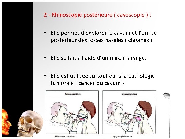 2 - Rhinoscopie postérieure ( cavoscopie ) : § Elle permet d’explorer le cavum