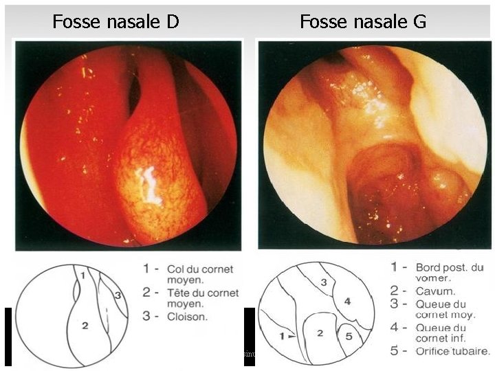 Fosse nasale D Fosse nasale G nez sinus 1 26 