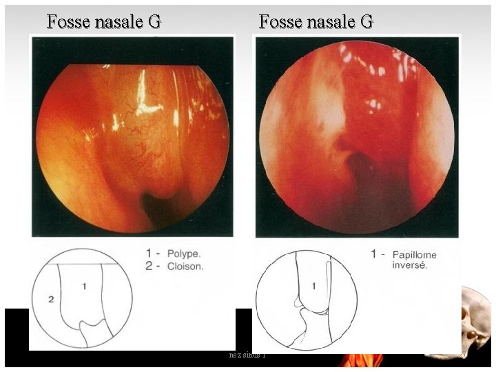 Fosse nasale G nez sinus 1 27 