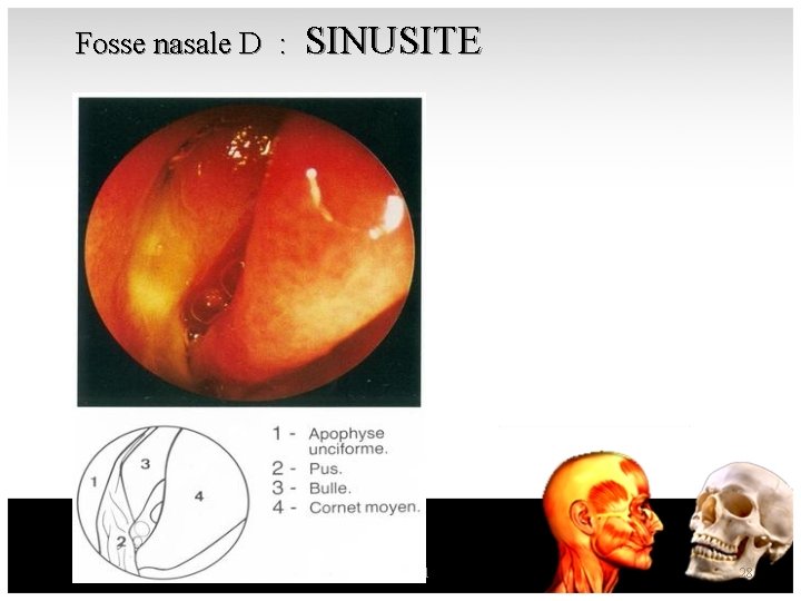 Fosse nasale D : SINUSITE nez sinus 1 28 