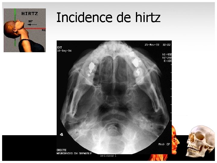 Incidence de hirtz nez sinus 1 33 