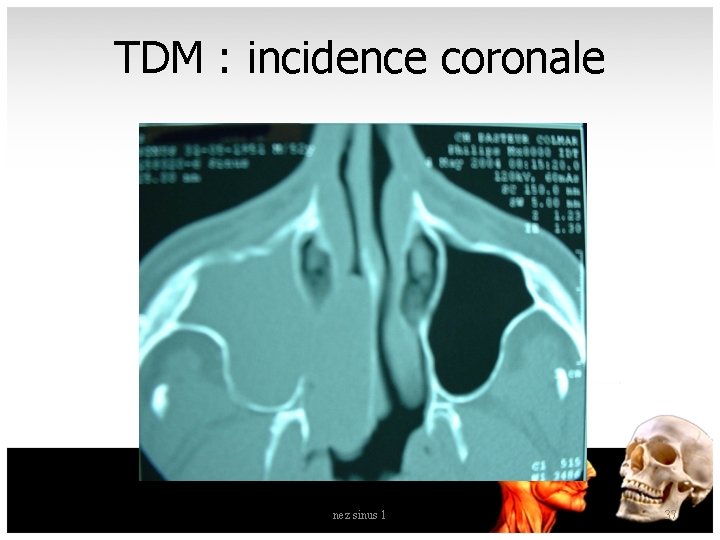 TDM : incidence coronale nez sinus 1 37 