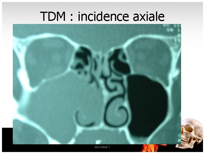 TDM : incidence axiale nez sinus 1 38 