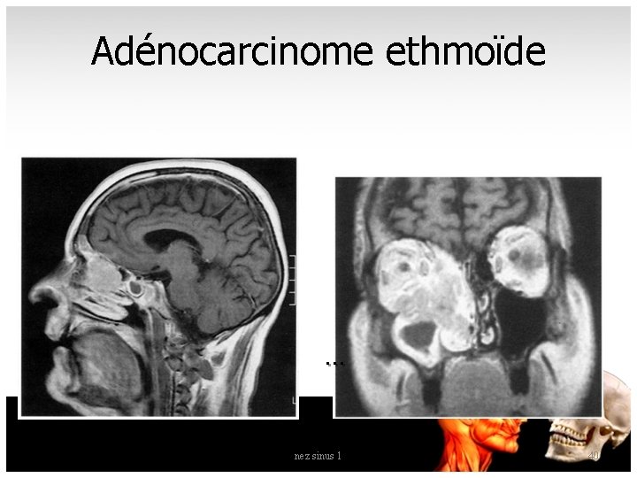 Adénocarcinome ethmoïde . . . nez sinus 1 40 