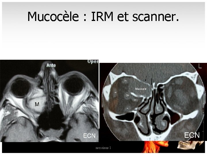 Mucocèle : IRM et scanner. nez sinus 1 41 