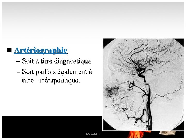 n Artériographie – Soit à titre diagnostique – Soit parfois également à titre thérapeutique.