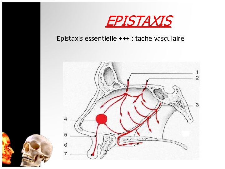 EPISTAXIS Epistaxis essentielle +++ : tache vasculaire 