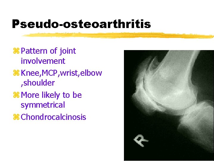 Pseudo-osteoarthritis z Pattern of joint involvement z Knee, MCP, wrist, elbow , shoulder z