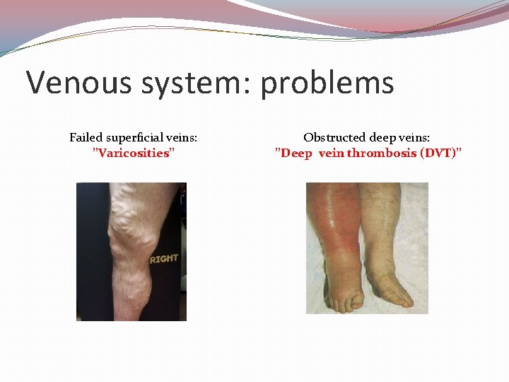 Venous system: problems Failed superficial veins: ’’Varicosities’’ Obstructed deep veins: ’’Deep vein thrombosis (DVT)’’