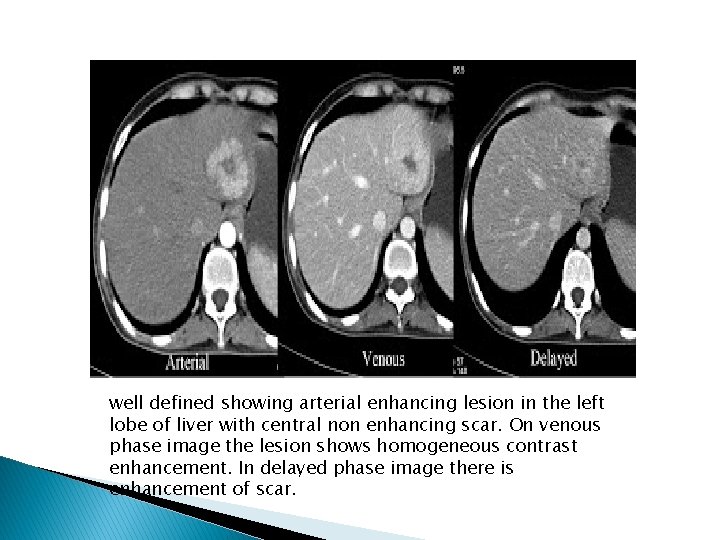 well defined showing arterial enhancing lesion in the left lobe of liver with central