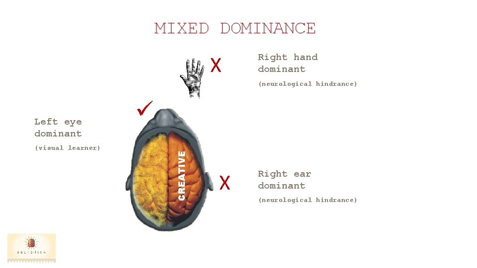 MIXED DOMINANCE X Right hand dominant (neurological hindrance) (visual learner) CREATIVE Left eye dominant