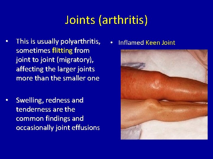 Joints (arthritis) • This is usually polyarthritis, • Inflamed Keen Joint sometimes flitting from