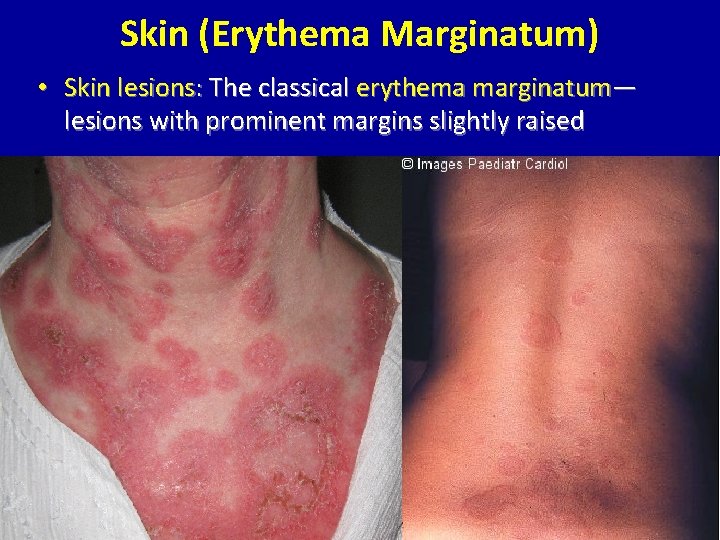 Skin (Erythema Marginatum) • Skin lesions: The classical erythema marginatum— lesions with prominent margins