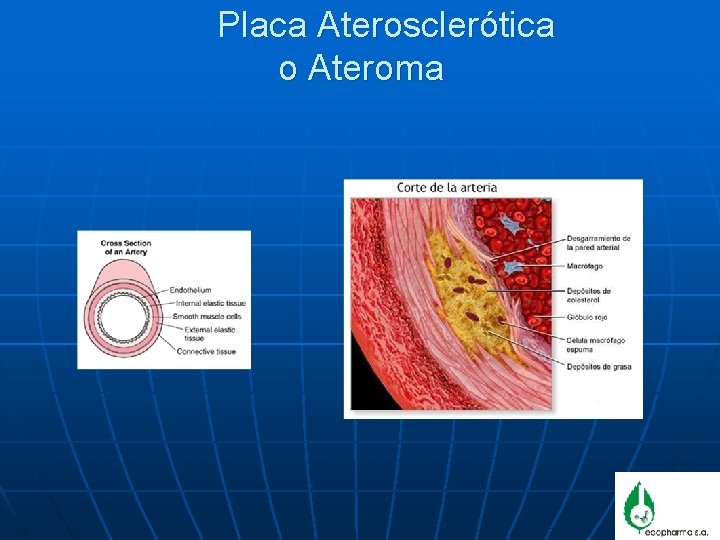 Placa Aterosclerótica o Ateroma 