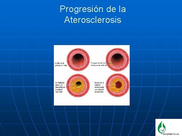 Progresión de la Aterosclerosis 