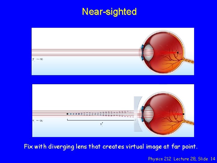 Near-sighted Fix with diverging lens that creates virtual image at far point. Physics 212