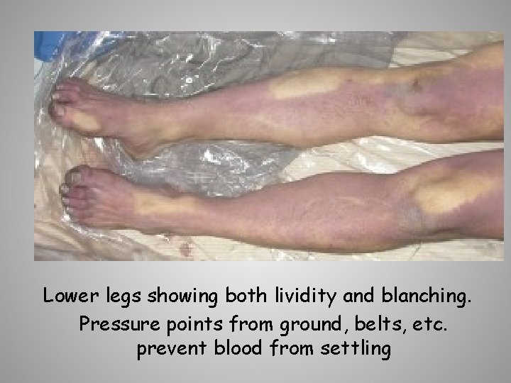 Lower legs showing both lividity and blanching. Pressure points from ground, belts, etc. prevent