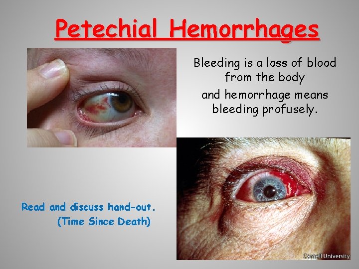 Petechial Hemorrhages Bleeding is a loss of blood from the body and hemorrhage means