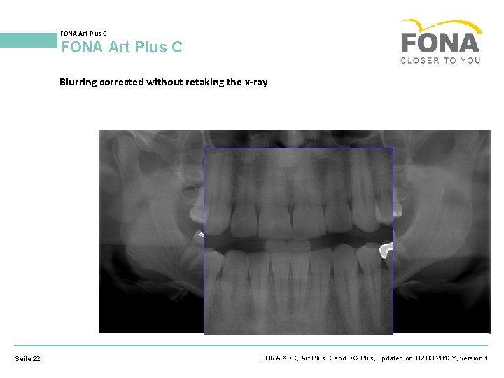 FONA Art Plus C Blurring corrected without retaking the x-ray Seite 22 FONA XDC,