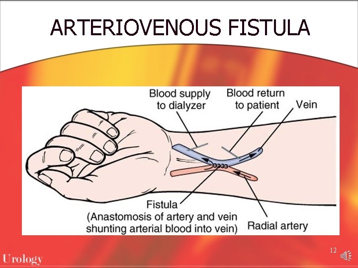 ARTERIOVENOUS FISTULA 12 