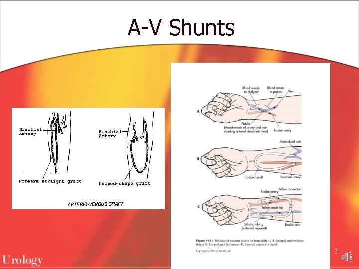 A-V Shunts 3 