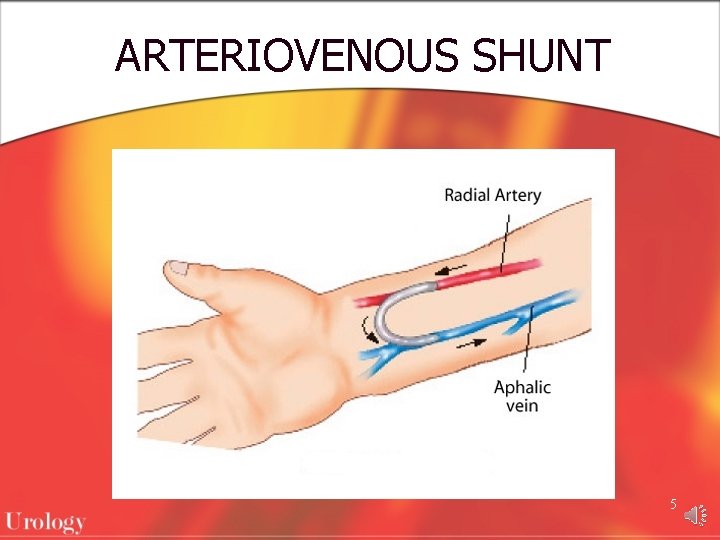 ARTERIOVENOUS SHUNT 5 