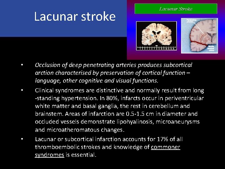 Lacunar stroke • • • Occlusion of deep penetrating arteries produces subcortical arction characterised