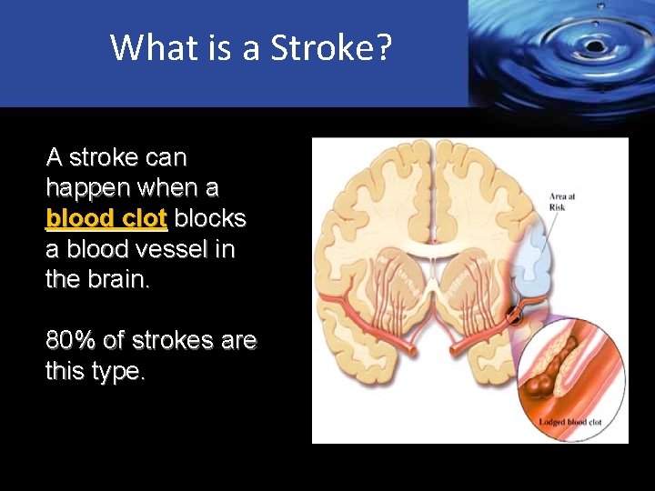 What is a Stroke? A stroke can happen when a blood clot blocks a