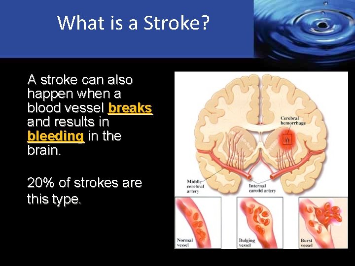 What is a Stroke? A stroke can also happen when a blood vessel breaks