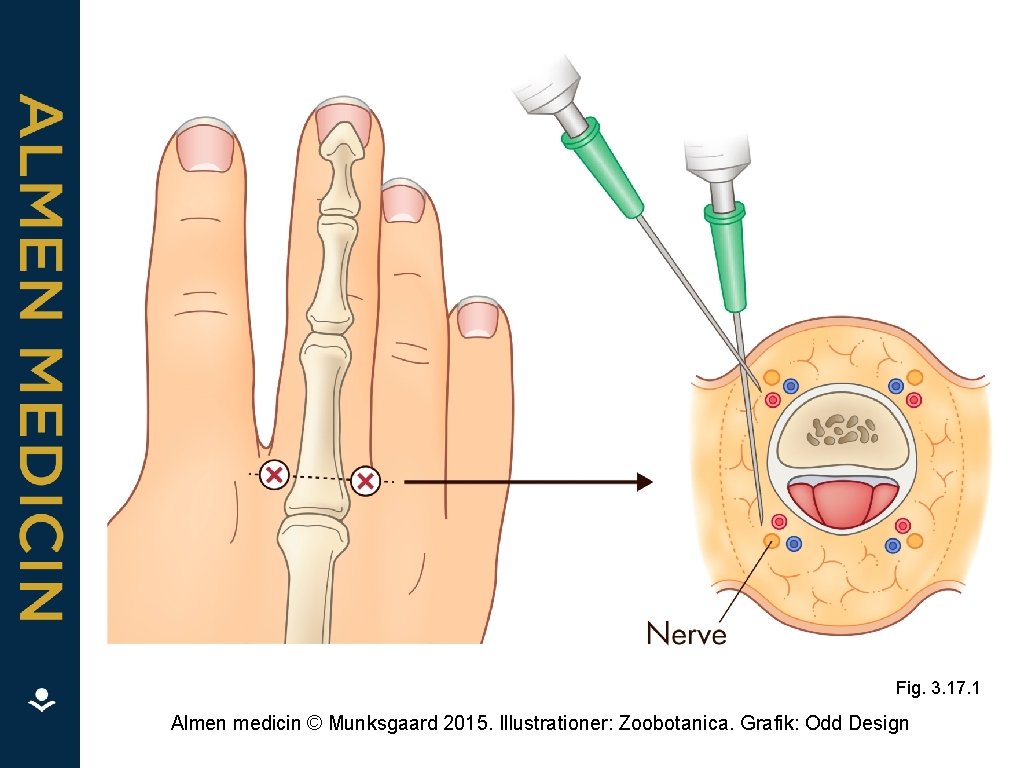 Fig. 3. 17. 1 Almen medicin © Munksgaard 2015. Illustrationer: Zoobotanica. Grafik: Odd Design