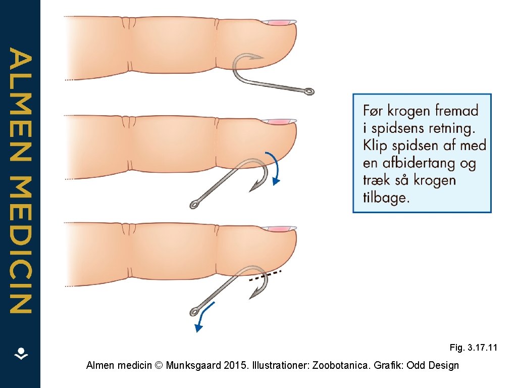 Fig. 3. 17. 11 Almen medicin © Munksgaard 2015. Illustrationer: Zoobotanica. Grafik: Odd Design