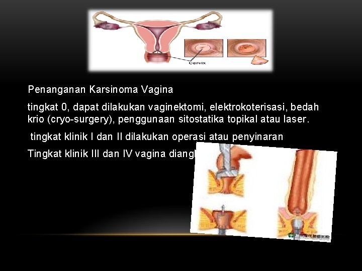 Penanganan Karsinoma Vagina tingkat 0, dapat dilakukan vaginektomi, elektrokoterisasi, bedah krio (cryo-surgery), penggunaan sitostatika