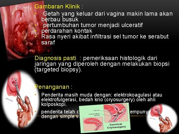 Gambaran Klinik : • Getah yang keluar dari vagina makin lama akan berbau busuk