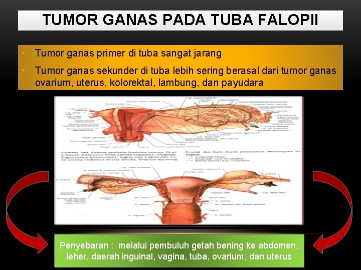 TUMOR GANAS PADA TUBA FALOPII • Tumor ganas primer di tuba sangat jarang •