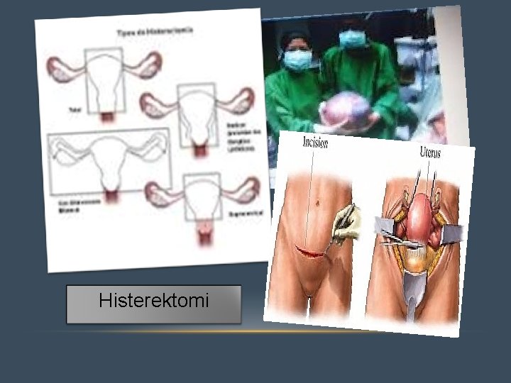 Histerektomi 