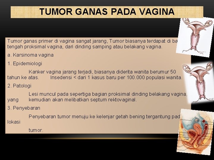 TUMOR GANAS PADA VAGINA Tumor ganas primer di vagina sangat jarang, Tumor biasanya terdapat