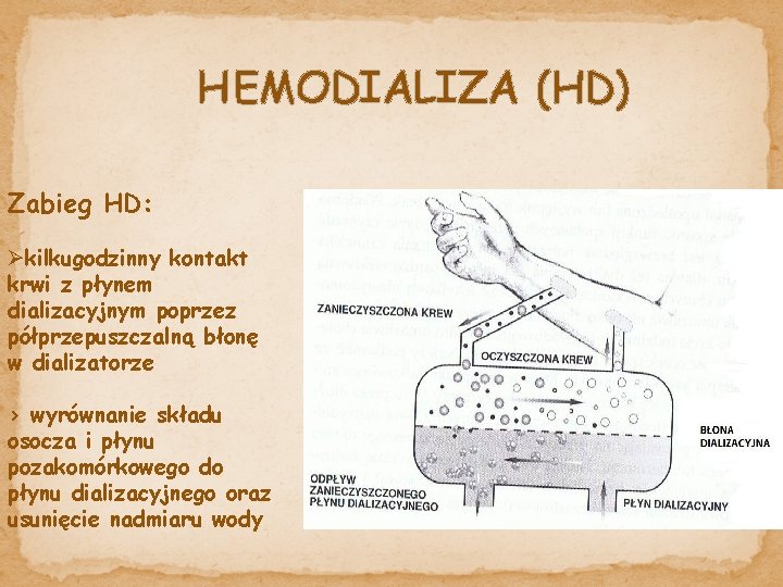 HEMODIALIZA (HD) Zabieg HD: Økilkugodzinny kontakt krwi z płynem dializacyjnym poprzez półprzepuszczalną błonę w