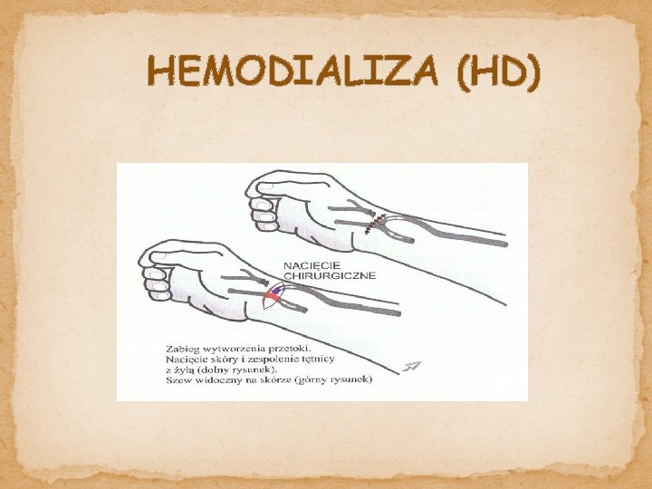 HEMODIALIZA (HD) 