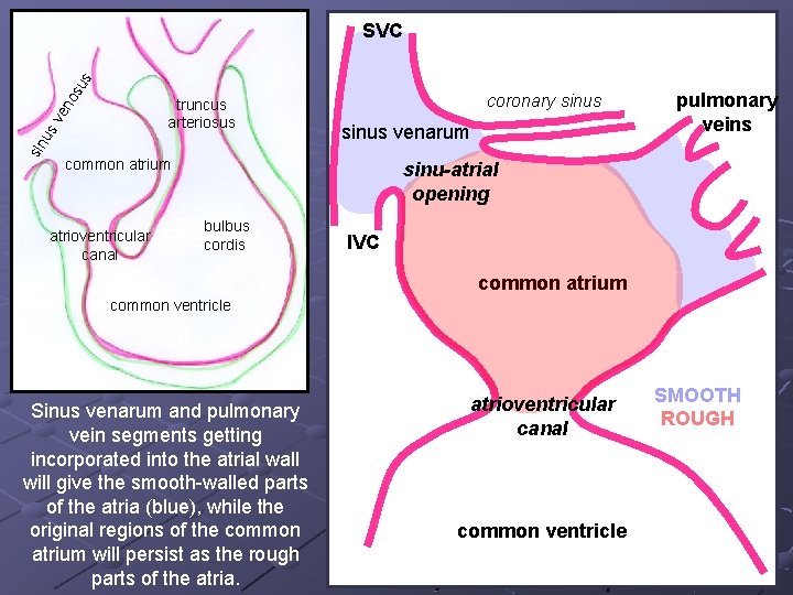 os us SVC sin u sv en truncus arteriosus coronary sinus venarum common atrium os us SVC sin u sv en truncus arteriosus coronary sinus venarum common atrium