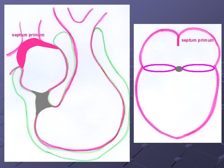 septum primum septum primum