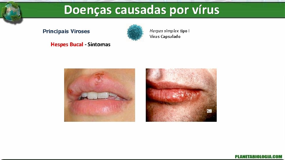 Doenças causadas por vírus Principais Viroses Hespes Bucal - Sintomas Herpes simplex tipo I