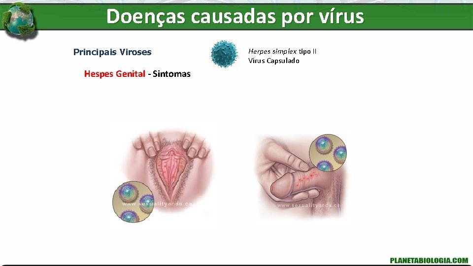 Doenças causadas por vírus Principais Viroses Hespes Genital - Sintomas Herpes simplex tipo II