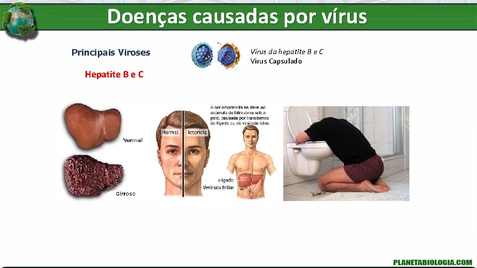 Doenças causadas por vírus Principais Viroses Hepatite B e C Vírus da hepatite B